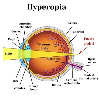 Illustration, die Hyperopie beschreibt