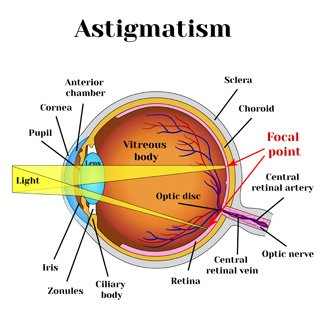 Illustration, die verschiedene Teile des Auges mit Astigmatismus beschreibt